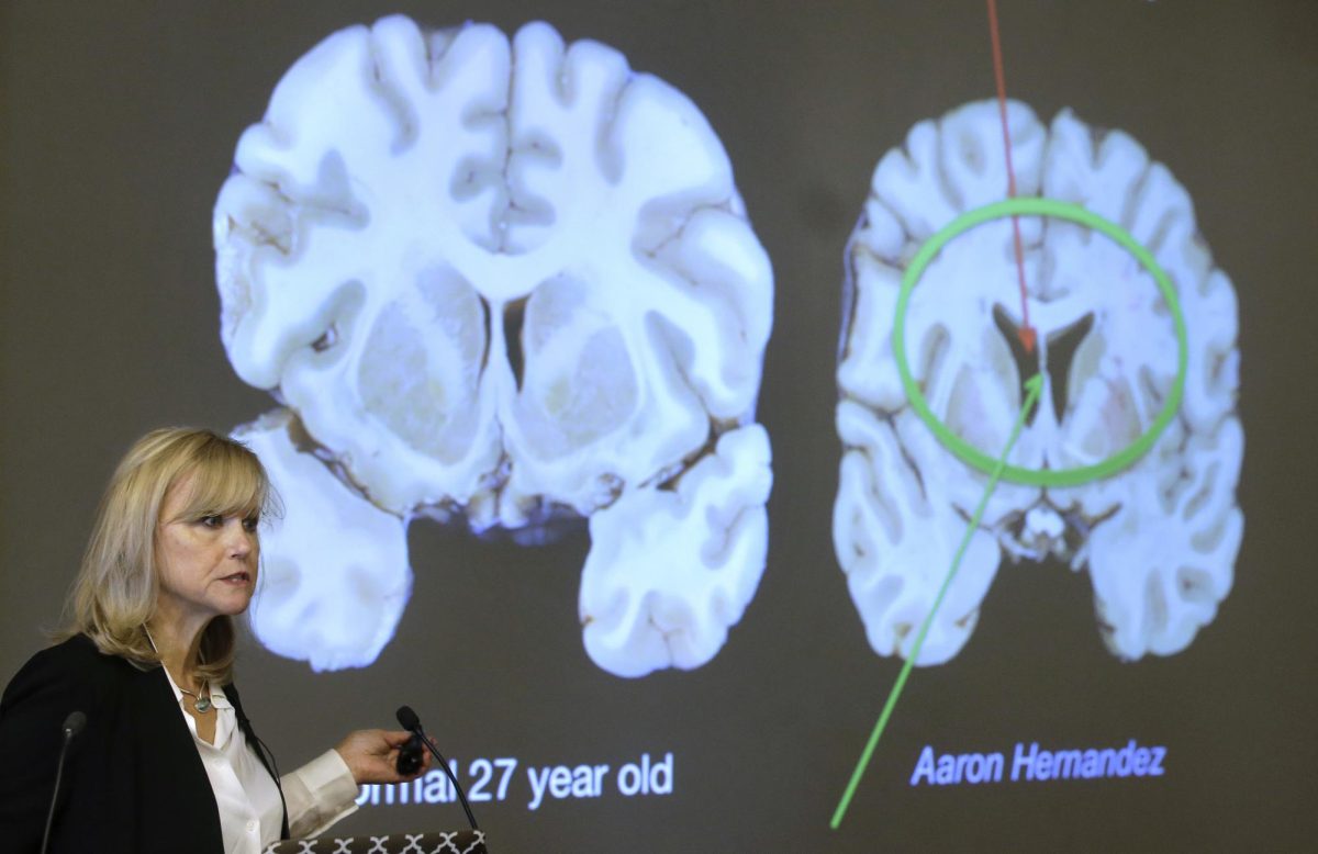 Photo courtesy of AP/Steven Senne. Ann McKee, director Boston University's center for research into the degenerative brain disease chronic traumatic encephalopathy, or CTE, addresses an audience on the school's campus Nov. 9, 2017 about the study of NFL football player Aaron Hernandez's brain, projected on a screen, behind right, in Boston. McKee says Hernandez suffered severe damage to parts of the brain that play an important role in memory, impulse control and behavior. The cross section of the brain projected behind left is labeled a normal 27 year old.